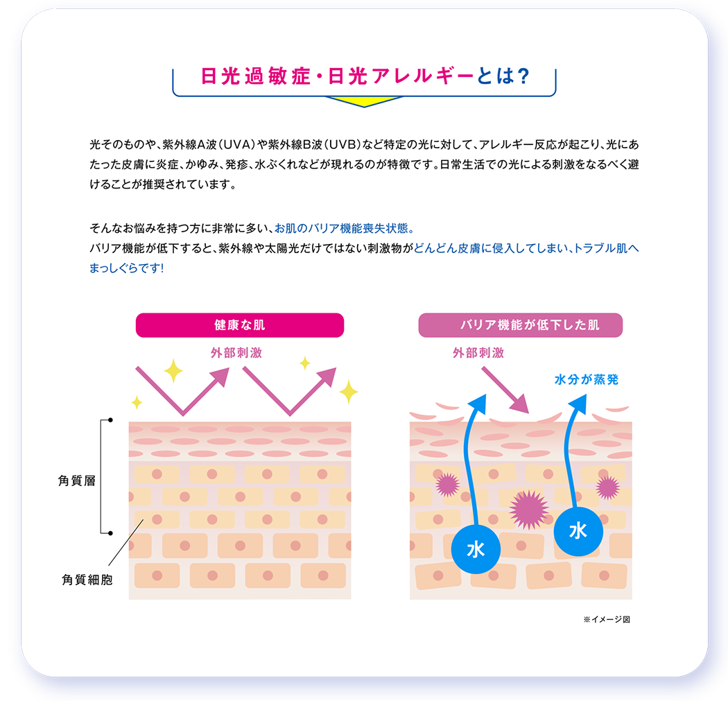 日光過敏症、日光アレルギーとは？